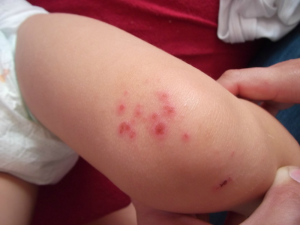 Testy alergiczne u dziecka