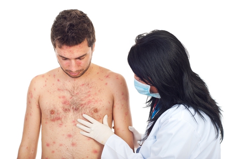 Swędzenie jako objaw alergii