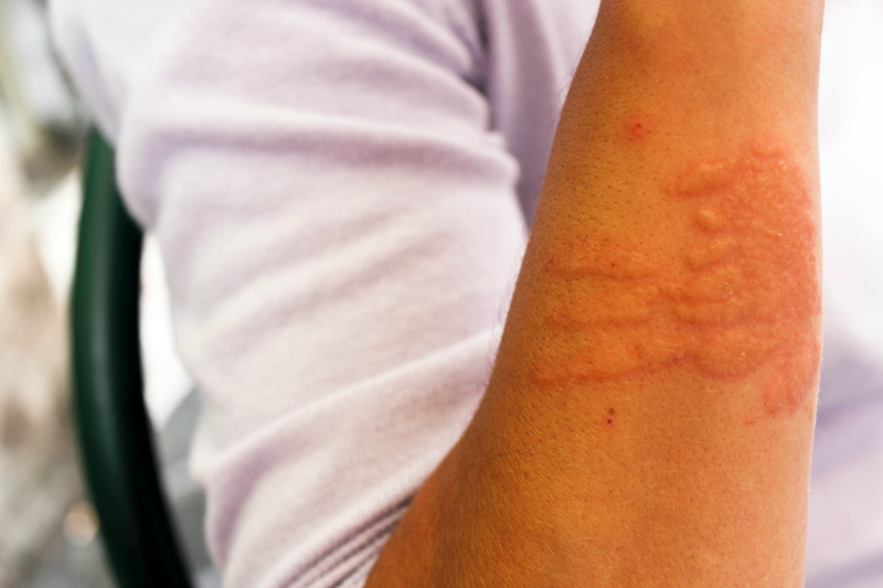Masz problemy ze skórą? Może to być jeden z objawów alergii!