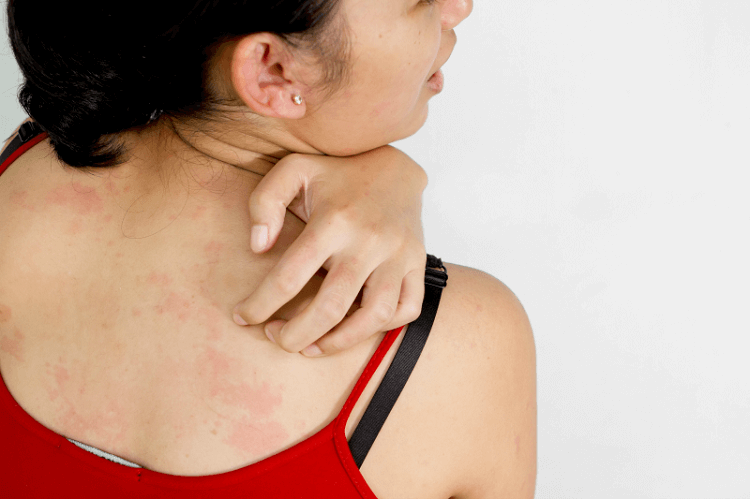 Atopowe zapalenie skóry – jak pielęgnować skórę
